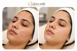 hydrafacial patient result glow
