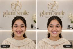 result of teeth removal clinic in Islamabad