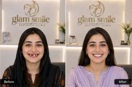 result of teeth removal in Islamabad