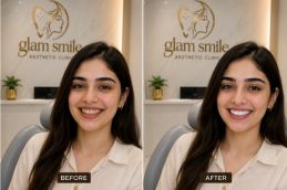 result of teetn whitning clinic in islamabad
