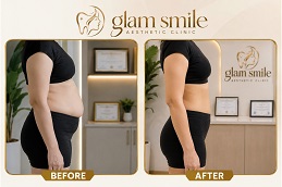 A Peek Into Your Liposuction Results