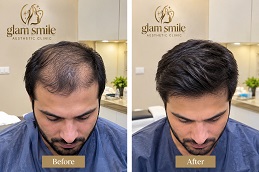 Before & After PRP in Islamabad