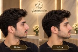 Before And After Of Rhinoplasty In Islamabad