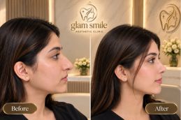 Before And After Of Rhinoplasty In Islamabad Pakistan