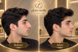 Before And After Results Of Rhinoplasty In Islamabad