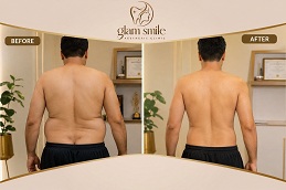 Liposuction Before & After Islamabad