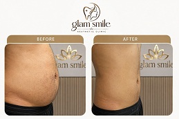 Liposuction Before & After Pakistan