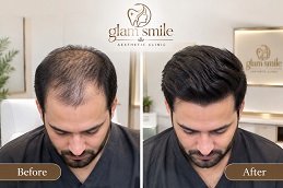 Result OF Hair Transplant Pakistan
