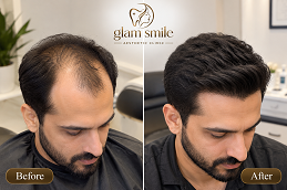Result OF Hair Transplant in Islamabad Pakistan
