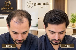 Results OF Hair Transplant in Islamabad