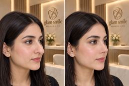 Results Of Rhinoplasty In Islamabad Pakistan