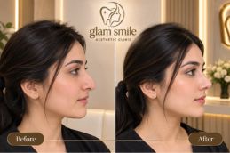 Results Of Rhinoplasty In Islamabad