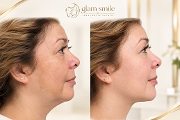 Results OF Microneedling Treatment Pakistan