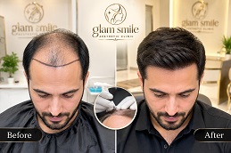 before & After Hair Transplant in Islamabad